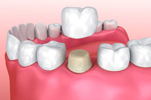 Comprehensive Dental Services in Oakville for All Your Needs 11 Crown And Bridges