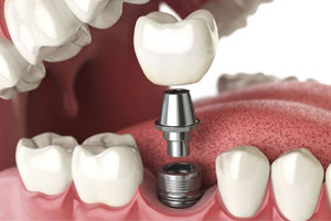 Comprehensive Dental Services in Oakville for All Your Needs 10 Dental Implants