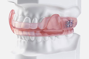 Comprehensive Dental Services in Oakville for All Your Needs 6 Sleep apnea appliances