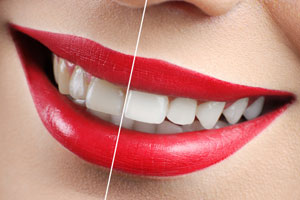 Comprehensive Dental Services in Oakville for All Your Needs 2 Teeth Whitening 2