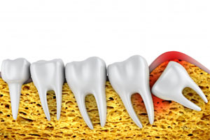Comprehensive Dental Services in Oakville for All Your Needs 13 Wisdom Teeth
