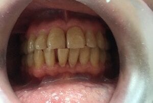 Invisalign Case