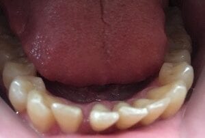 Invisalign Case