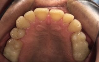 Invisalign Case