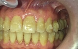 Invisalign Case