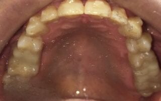 Invisalign Case