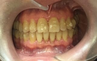 Invisalign Case