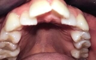 Invisalign Case