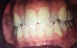 Invisalign Case