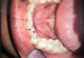 Invisalign Case