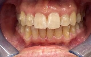 Invisalign Case