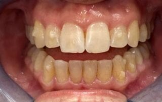 Invisalign Case