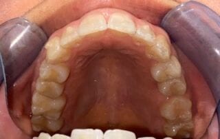 Invisalign Case