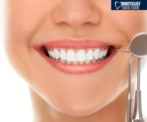 Teeth Whitening