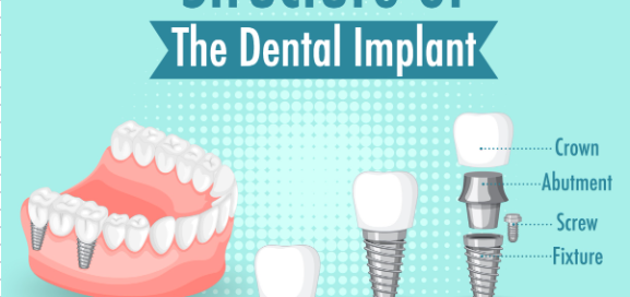 Choosing the Right Dental Implant Specialist: 5 Essential Factors to Consider 1 Dental Implants in Oakville