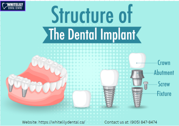 Dental Implants in Oakville
