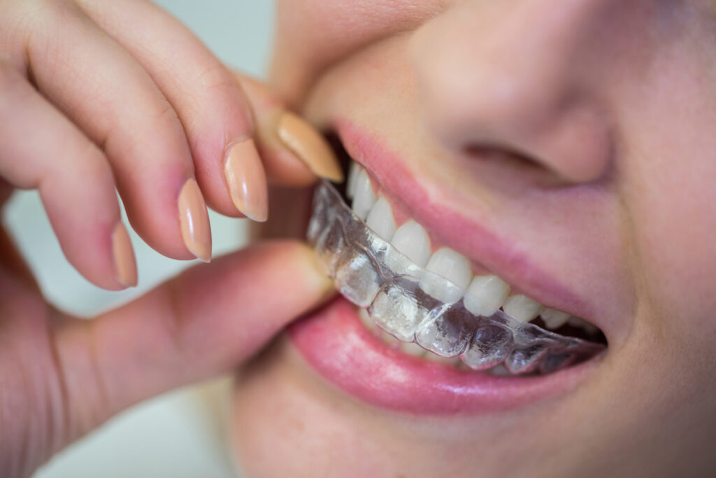 Invisalign in Oakville, ON