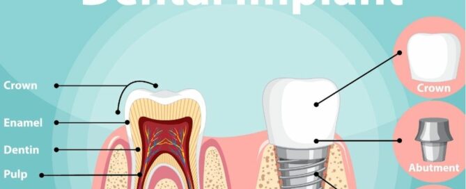 Cost Considerations for Dental Implants: What to Expect 1 Dental Implant Service