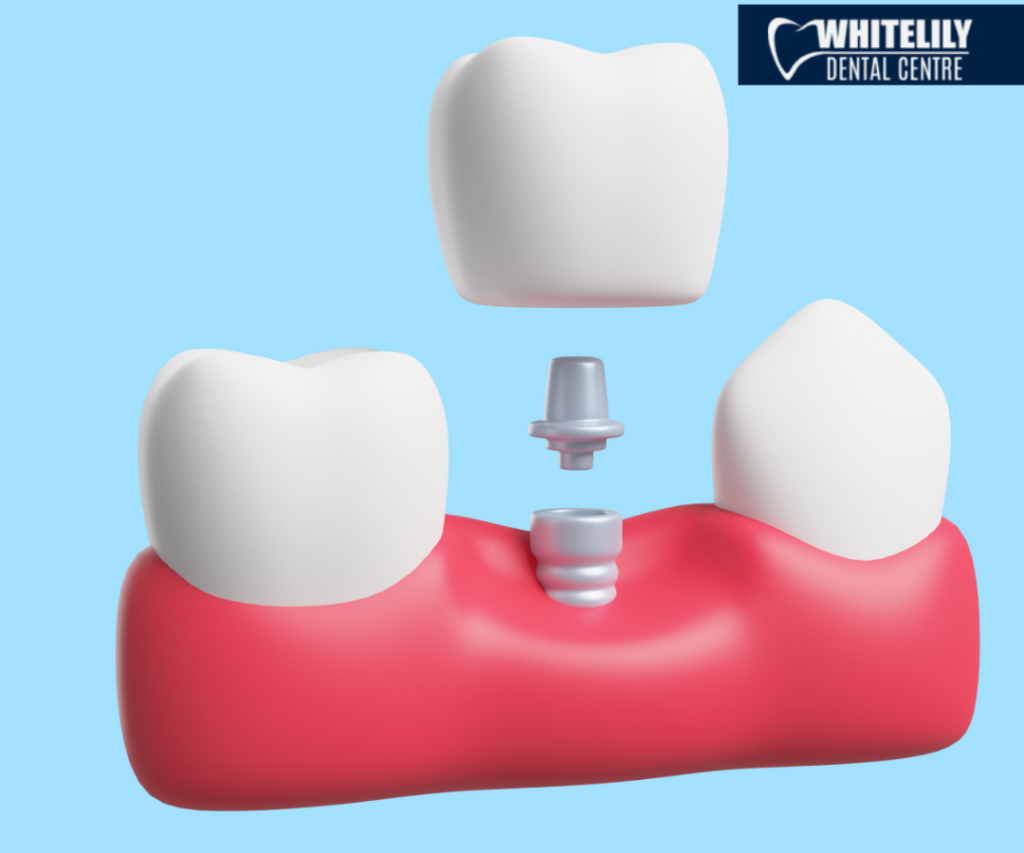 Dental implant