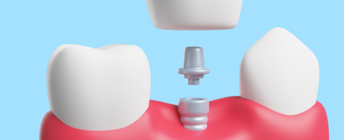 Your Journey to Dental Implants: Step-by-Step Guide 2 Dental implant