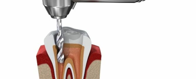 Signs You Might Need a Root Canal: When to Consult Your Dentist 1 Root canal treatment