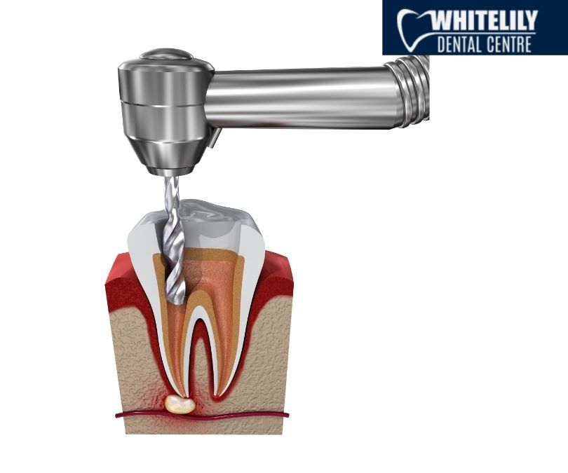 Root canal treatment