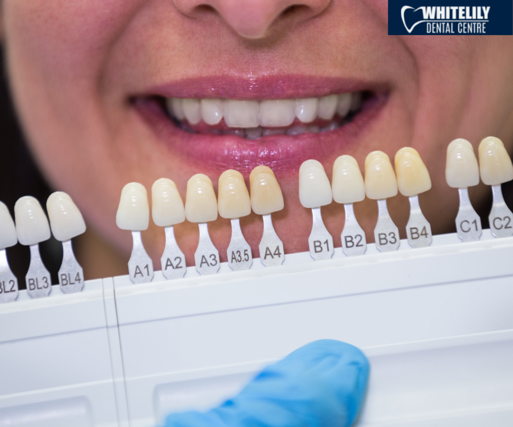 Teeth Whitening