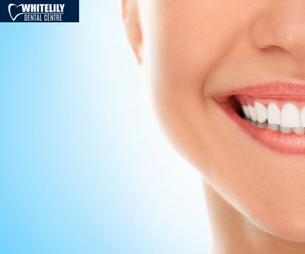 teeth whitening