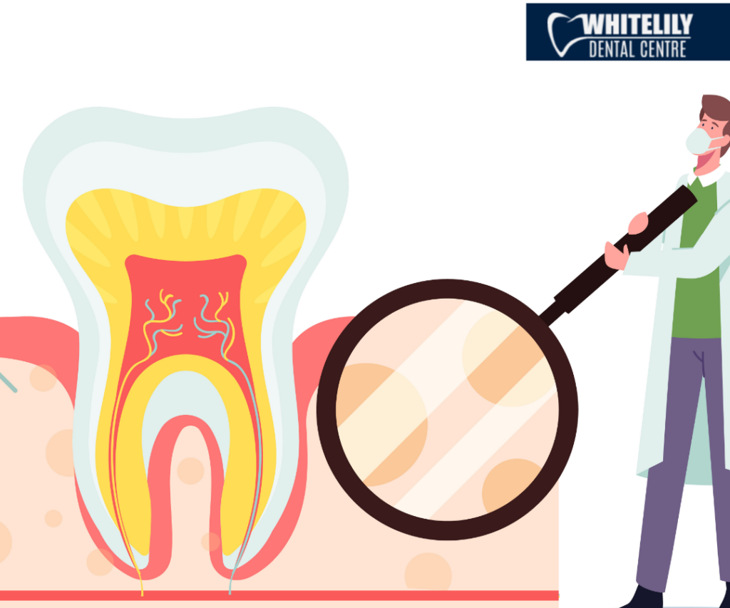 Root canal