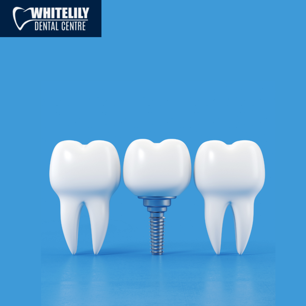 Dental implants in Oakville, ON