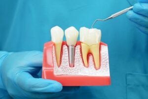 Trusted Dental Office in Oakville, ON – Family, Kids & Implants Care 1 Dental implants in Oakville ON